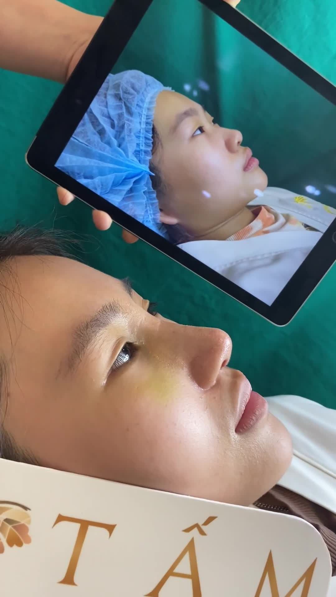 Sau 12 ngày nâng mũi Tái cấu trúc Reform, dáng mũi của nàng khách đã vào form xinh xỉu.